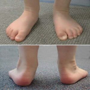 Flat foot with pronation